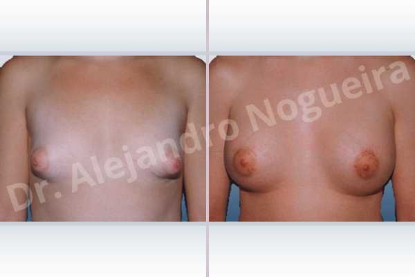 Asymmetric breasts,Cross eyed breasts,Large areolas,Lateral breasts,Narrow breasts,Small breasts,Too far apart wide cleavage breasts,Tuberous breasts,Anatomical shape,Areola reduction,Circumareolar incision,Subfascial pocket plane,Tuberous mammoplasty - photo 1