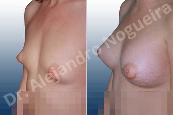 Asymmetric breasts,Cross eyed breasts,Large areolas,Lateral breasts,Narrow breasts,Small breasts,Too far apart wide cleavage breasts,Tuberous breasts,Anatomical shape,Areola reduction,Circumareolar incision,Subfascial pocket plane,Tuberous mammoplasty - photo 2