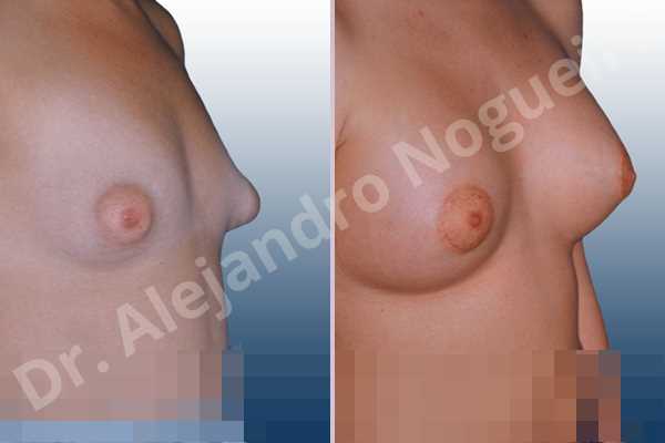 Asymmetric breasts,Cross eyed breasts,Large areolas,Lateral breasts,Narrow breasts,Small breasts,Too far apart wide cleavage breasts,Tuberous breasts,Anatomical shape,Areola reduction,Circumareolar incision,Subfascial pocket plane,Tuberous mammoplasty - photo 3