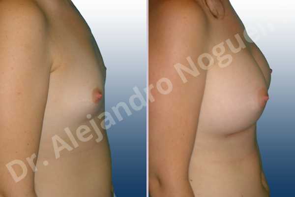 Lateral breasts,Narrow breasts,Small breasts,Too far apart wide cleavage breasts,Anatomical shape,Inframammary incision,Subfascial pocket plane - photo 4