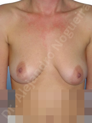 Asymmetric breasts,Breast tissue bottoming out,Cross eyed breasts,Empty breasts,Large areolas,Mildly saggy droopy breasts,Moderately saggy droopy breasts,Pendulous breasts,Slightly large breasts,Tuberous breasts,Anatomical shape,Areola reduction,Lollipop incision,Subfascial pocket plane,Superior pedicle