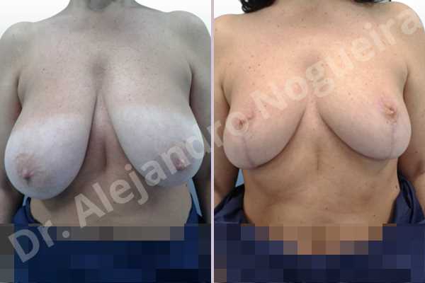 Asymmetric breasts,Breast tissue bottoming out,Extremely saggy droopy breasts,Large areolas,Lateral breasts,Pendulous breasts,Pigeon chest,Severely large breasts,Wide breasts,Tuberous breasts,Anchor incision,Areola reduction,Double vertical pedicle - photo 1