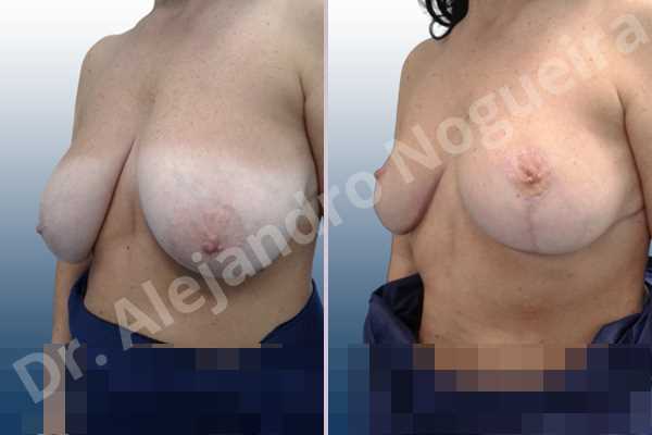 Asymmetric breasts,Breast tissue bottoming out,Extremely saggy droopy breasts,Large areolas,Lateral breasts,Pendulous breasts,Pigeon chest,Severely large breasts,Wide breasts,Tuberous breasts,Anchor incision,Areola reduction,Double vertical pedicle - photo 3