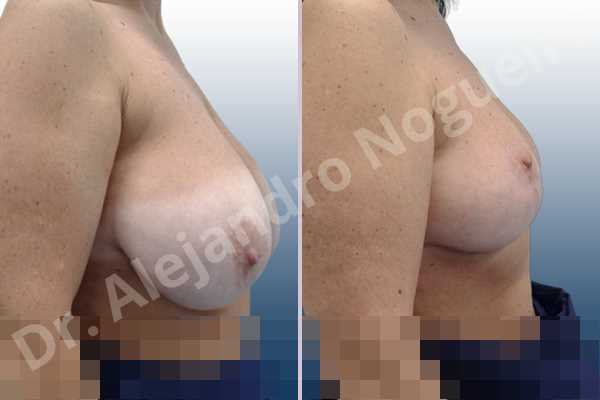 Asymmetric breasts,Breast tissue bottoming out,Extremely saggy droopy breasts,Large areolas,Lateral breasts,Pendulous breasts,Pigeon chest,Severely large breasts,Wide breasts,Tuberous breasts,Anchor incision,Areola reduction,Double vertical pedicle - photo 4