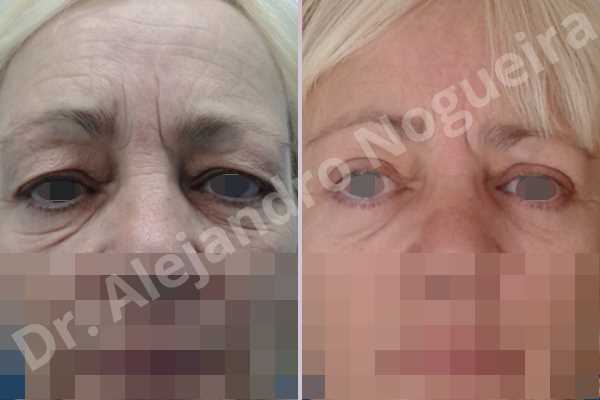 Baggy lower eyelids,Baggy upper eyelids,Saggy lower eyelids,Saggy upper eyelids,Upper eyelids ptosis,Lower eyelid fat bags resection,Lower eyelid skin and muscle resection,Lower eyelid wedge resection,Subciliary approach incision,Upper eyelid fat bags resection,Upper eyelid skin and muscle resection - photo 1