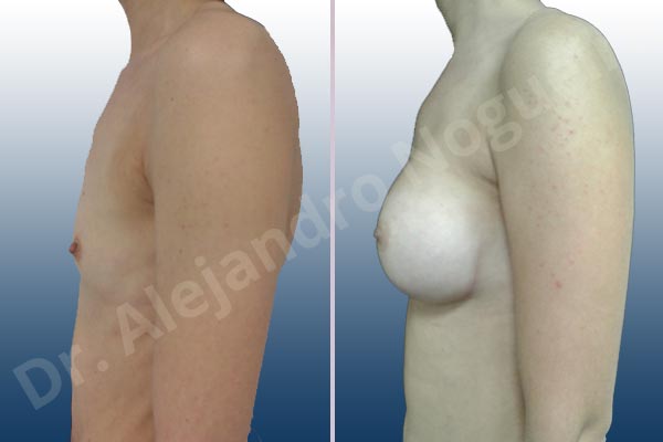 Lateral breasts,Narrow breasts,Skinny breasts,Small breasts,Sunken chest,Too far apart wide cleavage breasts,Anatomical shape,Inframammary incision,Subfascial pocket plane - photo 2