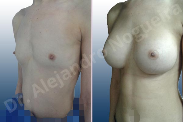 Lateral breasts,Narrow breasts,Skinny breasts,Small breasts,Sunken chest,Too far apart wide cleavage breasts,Anatomical shape,Inframammary incision,Subfascial pocket plane - photo 3