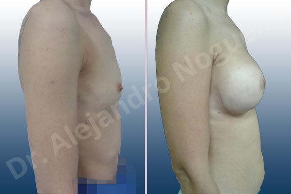 Lateral breasts,Narrow breasts,Skinny breasts,Small breasts,Sunken chest,Too far apart wide cleavage breasts,Anatomical shape,Inframammary incision,Subfascial pocket plane - photo 4