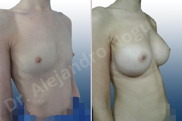 Lateral breasts,Narrow breasts,Skinny breasts,Small breasts,Sunken chest,Too far apart wide cleavage breasts,Anatomical shape,Inframammary incision,Subfascial pocket plane - photo 5