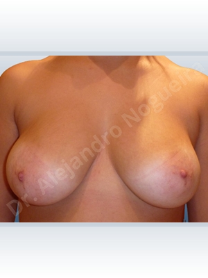 Asymmetric breasts,Cross eyed breasts,Large areolas,Lateral breasts,Mildly saggy droopy breasts,Moderately saggy droopy breasts,Lollipop incision,Superior pedicle