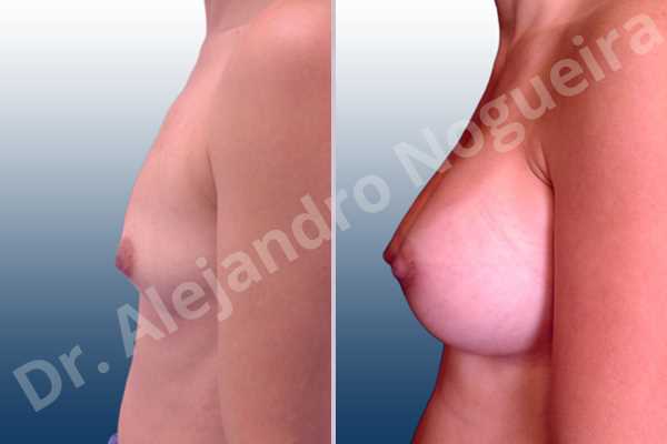 Asymmetric breasts,Cleft nipples,Empty breasts,Inverted nipples,Lateral breasts,Narrow breasts,Skinny breasts,Sunken chest,Too far apart wide cleavage breasts,Anatomical shape,Lower hemi periareolar incision,Subfascial pocket plane - photo 2