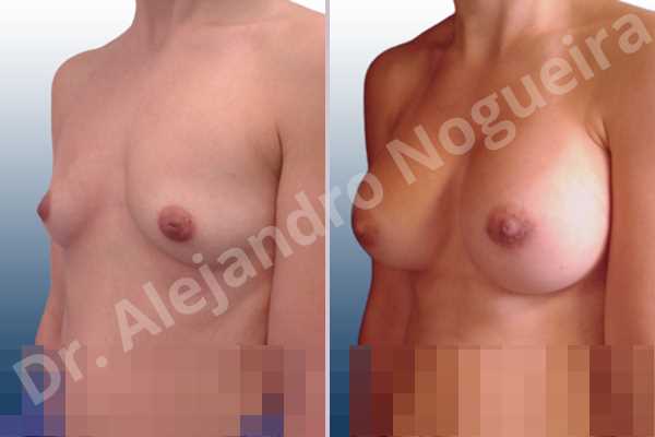 Asymmetric breasts,Cleft nipples,Empty breasts,Inverted nipples,Lateral breasts,Narrow breasts,Skinny breasts,Sunken chest,Too far apart wide cleavage breasts,Anatomical shape,Lower hemi periareolar incision,Subfascial pocket plane - photo 3