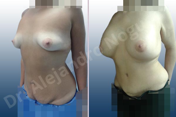 Empty breasts,Lateral breasts,Mildly saggy droopy breasts,Pigeon chest,Saggy abdomen,Small breasts,Too far apart wide cleavage breasts,Wide breasts,Anatomical shape,Lower hemi periareolar incision,Standard abdominoplasty,Subfascial pocket plane - photo 3