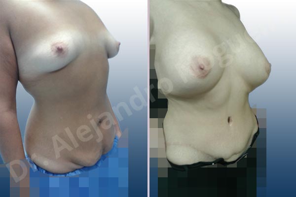 Empty breasts,Lateral breasts,Mildly saggy droopy breasts,Pigeon chest,Saggy abdomen,Small breasts,Too far apart wide cleavage breasts,Wide breasts,Anatomical shape,Lower hemi periareolar incision,Standard abdominoplasty,Subfascial pocket plane - photo 5