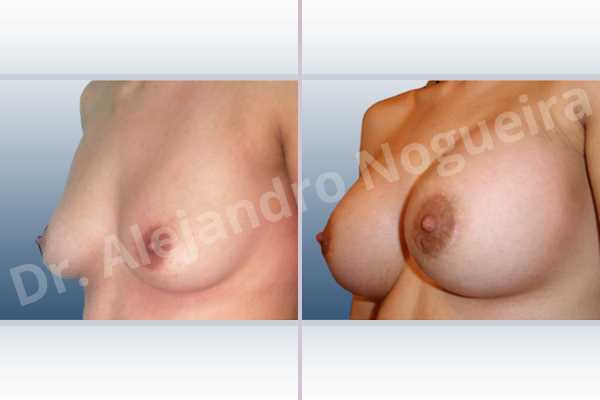 Empty breasts,Slightly saggy droopy breasts,Small breasts,Anatomical shape,Extra large size,Lower hemi periareolar incision,Subfascial pocket plane - photo 3