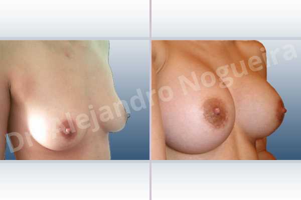 Empty breasts,Slightly saggy droopy breasts,Small breasts,Anatomical shape,Extra large size,Lower hemi periareolar incision,Subfascial pocket plane - photo 5
