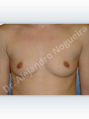 Skinny breasts,Small breasts,Lower hemi periareolar incision,Round shape,Subfascial pocket plane