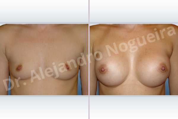 Skinny breasts,Small breasts,Lower hemi periareolar incision,Round shape,Subfascial pocket plane - photo 1