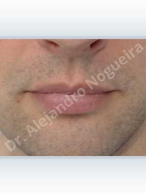 Small lips,Transgender lips,Upper lip autologous dermis collagen filler