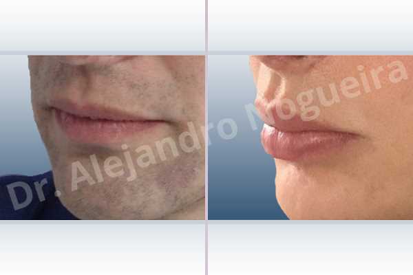 Small lips,Transgender lips,Upper lip autologous dermis collagen filler - photo 4
