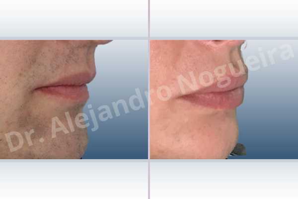 Small lips,Transgender lips,Upper lip autologous dermis collagen filler - photo 6