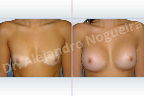 Cross eyed breasts,Narrow breasts,Small breasts,Anatomical shape,Inframammary incision,Subfascial pocket plane - photo 1