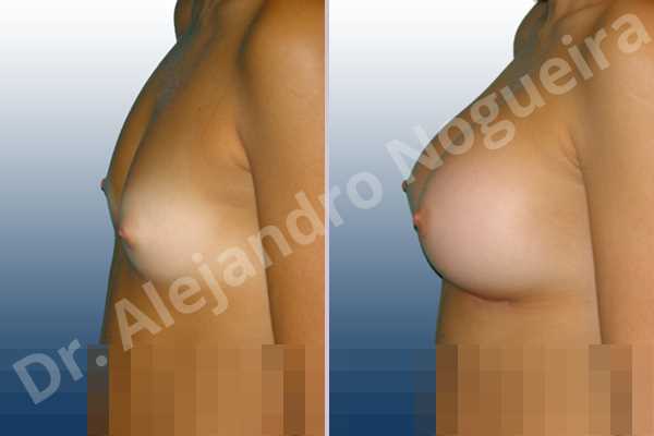 Cross eyed breasts,Narrow breasts,Small breasts,Anatomical shape,Inframammary incision,Subfascial pocket plane - photo 2
