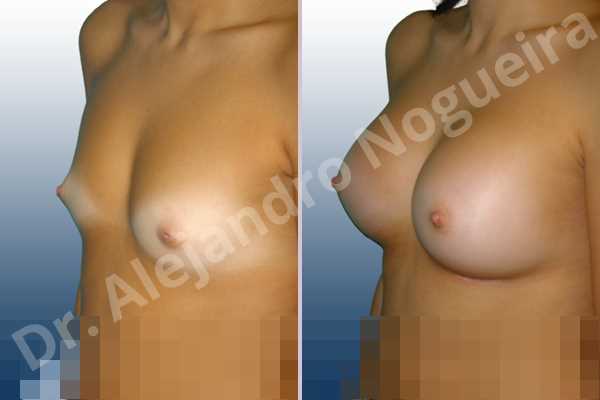 Cross eyed breasts,Narrow breasts,Small breasts,Anatomical shape,Inframammary incision,Subfascial pocket plane - photo 3
