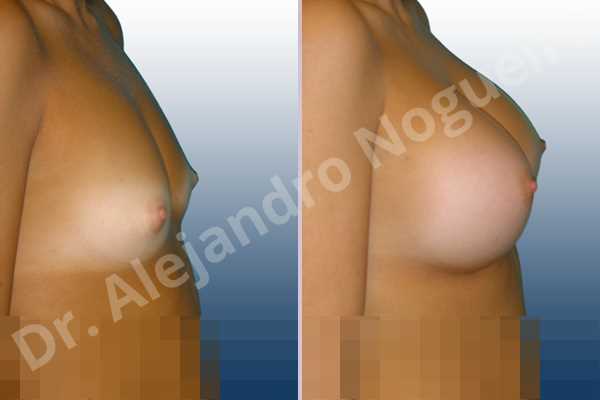 Cross eyed breasts,Narrow breasts,Small breasts,Anatomical shape,Inframammary incision,Subfascial pocket plane - photo 4