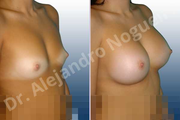 Cross eyed breasts,Narrow breasts,Small breasts,Anatomical shape,Inframammary incision,Subfascial pocket plane - photo 5