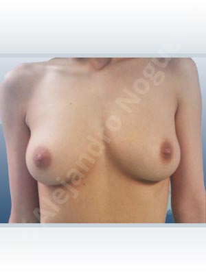 Empty breasts,Lateral breasts,Slightly saggy droopy breasts,Small breasts,Extra large size,Lower hemi periareolar incision,Round shape,Subfascial pocket plane