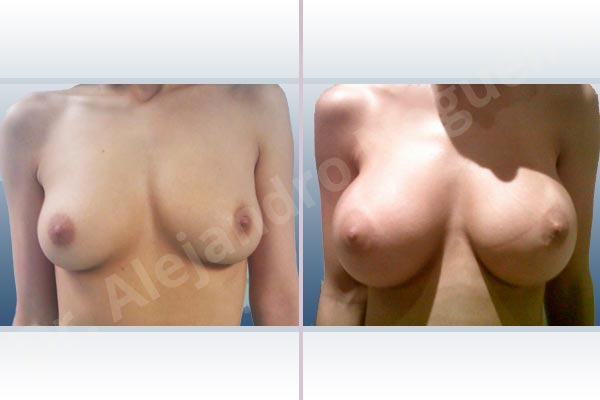Empty breasts,Lateral breasts,Slightly saggy droopy breasts,Small breasts,Extra large size,Lower hemi periareolar incision,Round shape,Subfascial pocket plane - photo 1