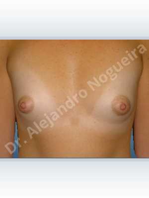 Lateral breasts,Narrow breasts,Too far apart wide cleavage breasts,Tuberous breasts,Lower hemi periareolar incision,Round shape,Subfascial pocket plane,Tuberous mammoplasty