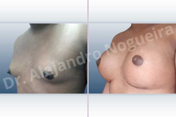 Cross eyed breasts,Empty breasts,Hypertrophic scars,Keloid scars,Lateral breasts,Pigeon chest,Pigmented scars,Small breasts,Too far apart wide cleavage breasts,Wide breasts,Transgender breasts,Inframammary incision,Round shape,Subfascial pocket plane - photo 3