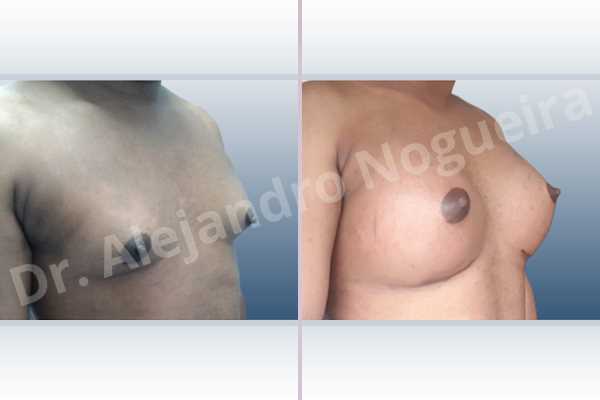 Cross eyed breasts,Empty breasts,Hypertrophic scars,Keloid scars,Lateral breasts,Pigeon chest,Pigmented scars,Small breasts,Too far apart wide cleavage breasts,Wide breasts,Transgender breasts,Inframammary incision,Round shape,Subfascial pocket plane - photo 5
