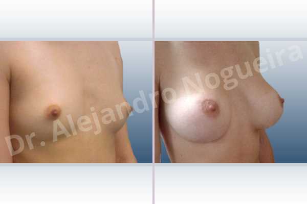 Asymmetric breasts,Lateral breasts,Narrow breasts,Skinny breasts,Small breasts,Sunken chest,Too far apart wide cleavage breasts,Anatomical shape,Lower hemi periareolar incision,Subfascial pocket plane - photo 5