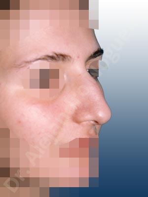 Broad nose,Dorsum hump,Droopy tip,Dynamic alar flaring,Large alar cartilages,Large nose,Long nose,Long upper lateral cartilages,Mediterranean nose,Overprojected tip,Plunging tip deformity,Closed approach incision,Dorsum hump resection,Lateral cruras cephalic resection,Lateral cruras shortening resection,Medial cruras shortening resection,Nasal bones osteotomies,Triangular cartilages caudal resection