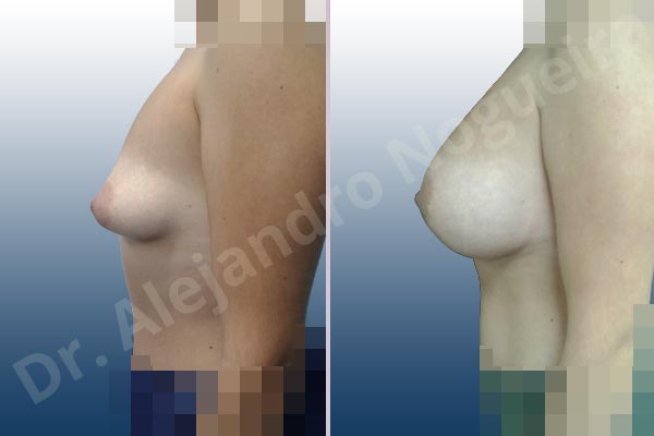 Asymmetric breasts,Cleft nipples,Empty breasts,Inverted nipples,Lateral breasts,Mildly saggy droopy breasts,Moderately saggy droopy breasts,Pigeon chest,Small breasts,Too far apart wide cleavage breasts,Tuberous breasts,Wide breasts,Anatomical shape,Extra large size,Lower hemi periareolar incision,Subfascial pocket plane,Tuberous mammoplasty - photo 2
