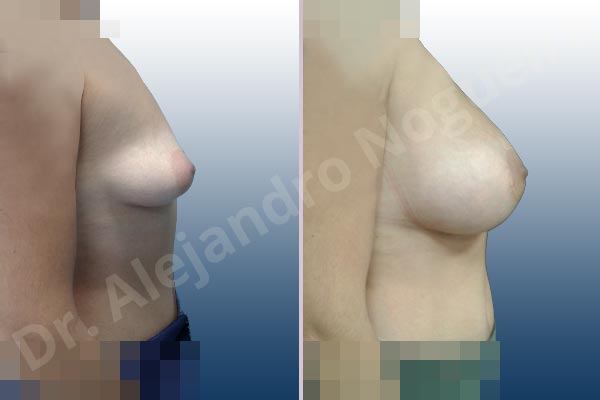 Asymmetric breasts,Cleft nipples,Empty breasts,Inverted nipples,Lateral breasts,Mildly saggy droopy breasts,Moderately saggy droopy breasts,Pigeon chest,Small breasts,Too far apart wide cleavage breasts,Tuberous breasts,Wide breasts,Anatomical shape,Extra large size,Lower hemi periareolar incision,Subfascial pocket plane,Tuberous mammoplasty - photo 4