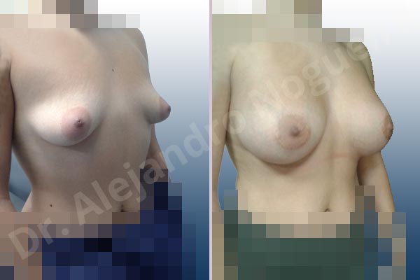 Asymmetric breasts,Cleft nipples,Empty breasts,Inverted nipples,Lateral breasts,Mildly saggy droopy breasts,Moderately saggy droopy breasts,Pigeon chest,Small breasts,Too far apart wide cleavage breasts,Tuberous breasts,Wide breasts,Anatomical shape,Extra large size,Lower hemi periareolar incision,Subfascial pocket plane,Tuberous mammoplasty - photo 5