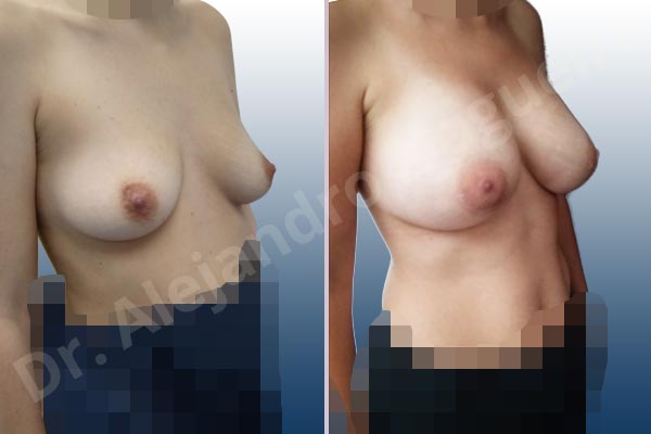 Asymmetric breasts,Narrow breasts,Slightly saggy droopy breasts,Small breasts,Empty breasts,Anatomical shape,Lower hemi periareolar incision,Subfascial pocket plane - photo 5