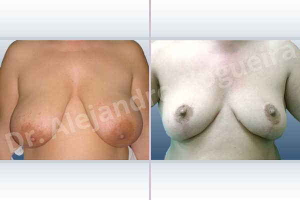 Cross eyed breasts,Extremely saggy droopy breasts,Pendulous breasts,Pigmented scars,Severely saggy droopy breasts,Wide breasts,Anchor incision,Double vertical pedicle - photo 1