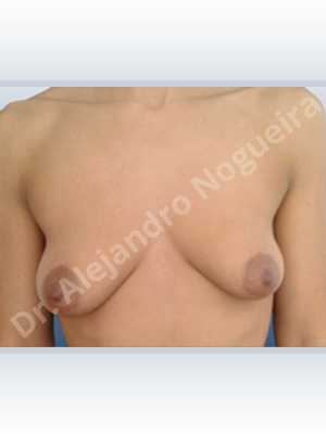 Asymmetric breasts,Empty breasts,Lateral breasts,Mildly saggy droopy breasts,Moderately saggy droopy breasts,Pendulous breasts,Small breasts,Tuberous breasts,Anatomical shape,Lower hemi periareolar incision,Subfascial pocket plane,Tuberous mammoplasty