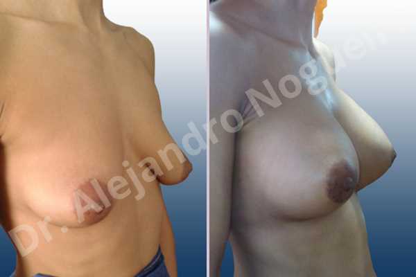Asymmetric breasts,Empty breasts,Lateral breasts,Mildly saggy droopy breasts,Moderately saggy droopy breasts,Pendulous breasts,Small breasts,Tuberous breasts,Anatomical shape,Lower hemi periareolar incision,Subfascial pocket plane,Tuberous mammoplasty - photo 5