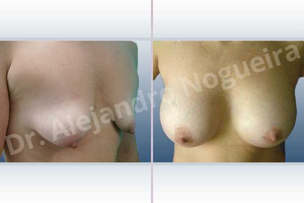 Asymmetric breasts,Empty breasts,Moderately saggy droopy breasts,Pendulous breasts,Severely saggy droopy breasts,Small breasts,Tuberous breasts,Anatomical shape,Lower hemi periareolar incision,Subfascial pocket plane,Tuberous mammoplasty - photo 5