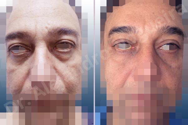 Baggy lower eyelids,Baggy upper eyelids,Deep nasolabial folds,Droopy cheeks,Droopy eyebrows,Droopy face,Droopy forehead,Saggy upper eyelids,Lower eyelid fat bags resection,Short temporal incisions supraperiosteal extended lift of the upper two thirds of the face,Transconjunctival approach incision,Upper eyelid fat bags resection,Upper eyelid skin and muscle resection - photo 1