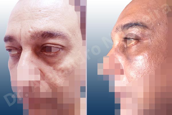 Baggy lower eyelids,Baggy upper eyelids,Deep nasolabial folds,Droopy cheeks,Droopy eyebrows,Droopy face,Droopy forehead,Saggy upper eyelids,Lower eyelid fat bags resection,Short temporal incisions supraperiosteal extended lift of the upper two thirds of the face,Transconjunctival approach incision,Upper eyelid fat bags resection,Upper eyelid skin and muscle resection - photo 3