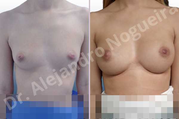 Cleft nipples,Cross eyed breasts,Empty breasts,Inverted nipples,Small breasts,Too far apart wide cleavage breasts,Wide scars,Anatomical shape,Lower hemi periareolar incision,Subfascial pocket plane - photo 1