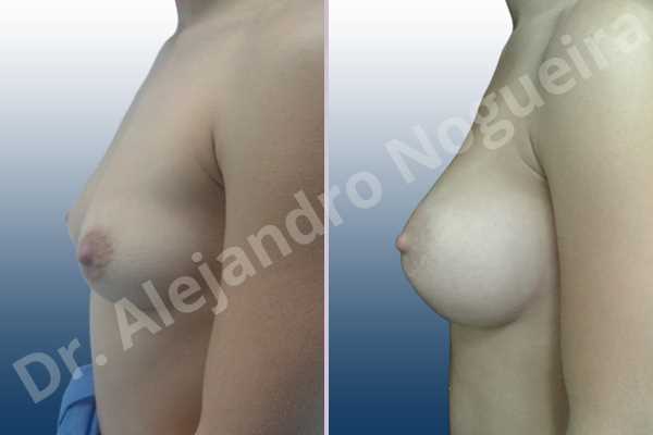 Asymmetric breasts,Cross eyed breasts,Empty breasts,Lateral breasts,Slightly saggy droopy breasts,Small breasts,Sunken chest,Too far apart wide cleavage breasts,Anatomical shape,Lower hemi periareolar incision,Subfascial pocket plane - photo 2