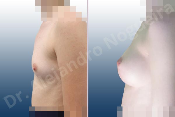 Empty breasts,Lateral breasts,Narrow breasts,Skinny breasts,Small breasts,Too far apart wide cleavage breasts,Anatomical shape,Inframammary incision,Subfascial pocket plane - photo 2